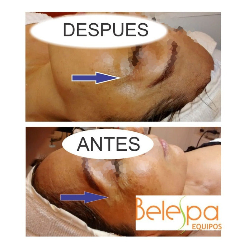 Mini Hifu Portatil +rejuvenecimiento Facial + Envio Gratis