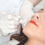 Plasmapen Fibroblast Elimina Tatuaje Verruga Mezquino Mancha