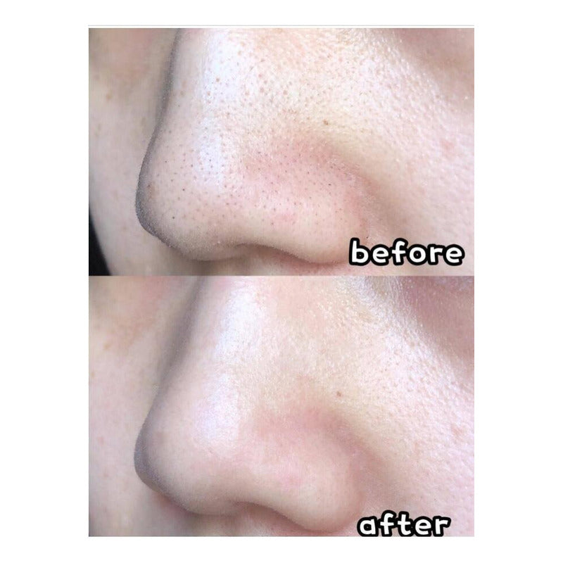 Limpiador Hidrafacial Hidrodermoabrasion Poros Puntos Negros