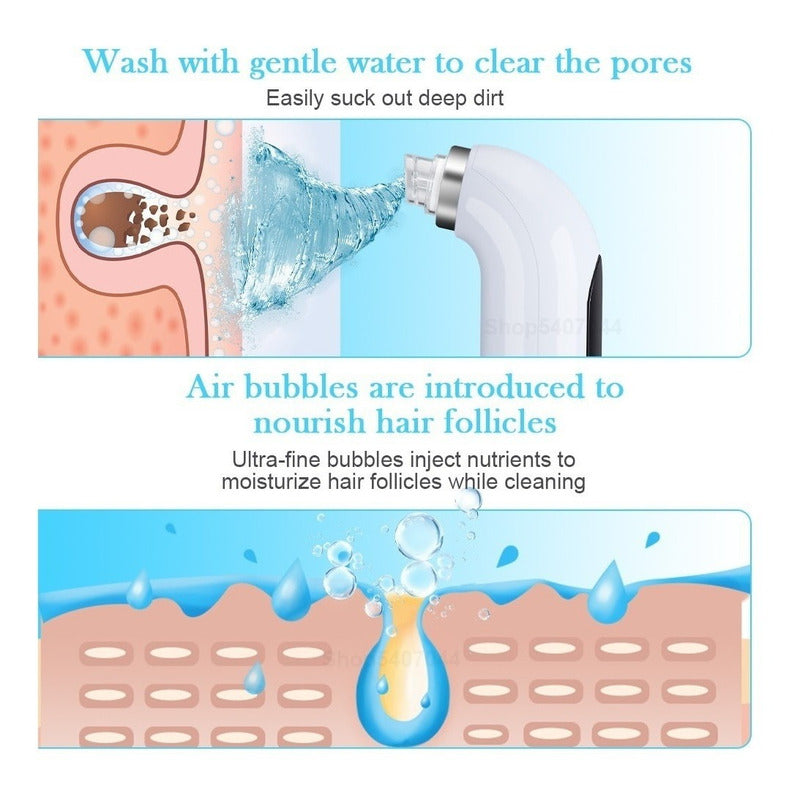 Hidrodermoabrasión Removedor De Espinillas, Puntos Negros