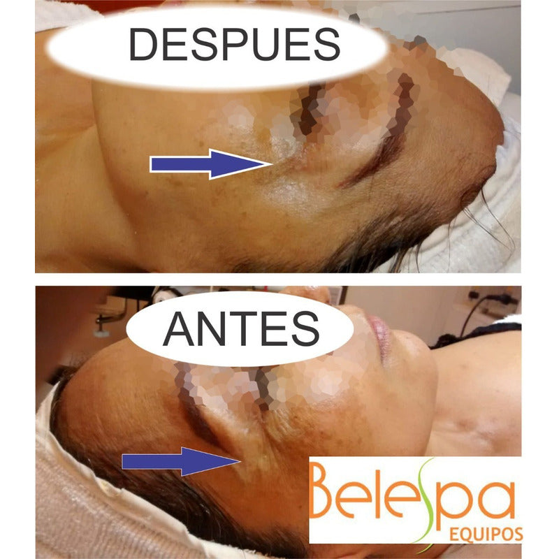 Maquina Reafirmante Linfting Rejuvenecimiento Mini Hifu