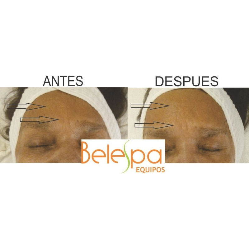 Maquina Reafirmante Linfting Rejuvenecimiento Mini Hifu