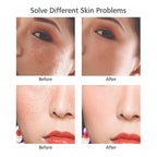 Plasmapen Fibroblast Elimina Tatuaje Verruga Mezquino Mancha