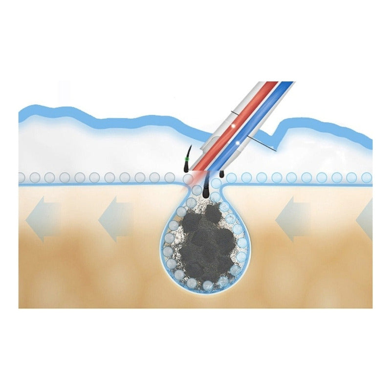 Limpiador Hidrafacial Hidrodermoabrasion Poros Puntos Negros