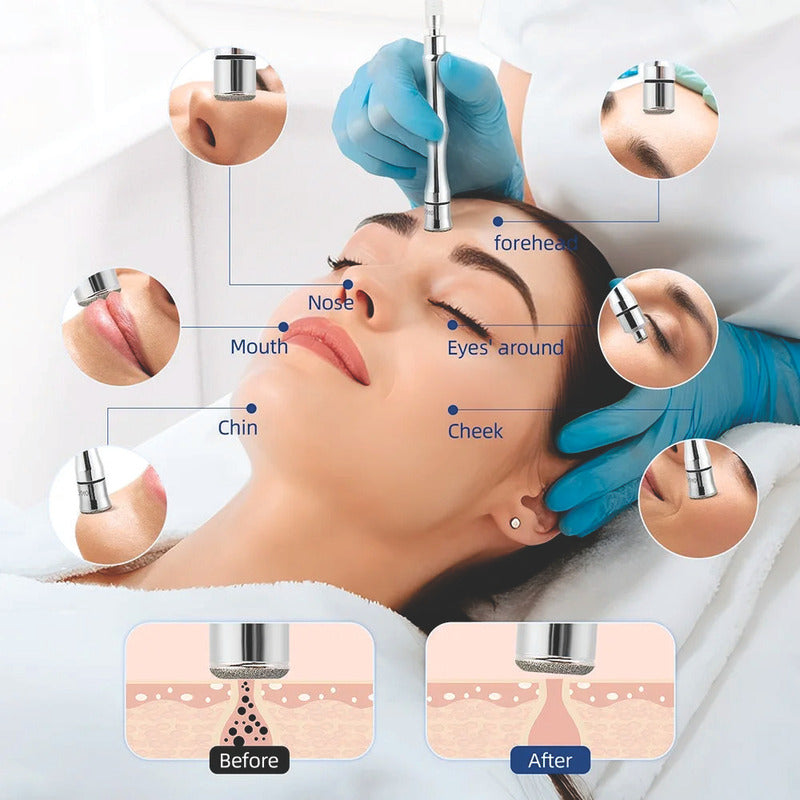 Set Puntas Diamante Microdermoabrasion Spa Exfoliar Todo Tipo De Piel