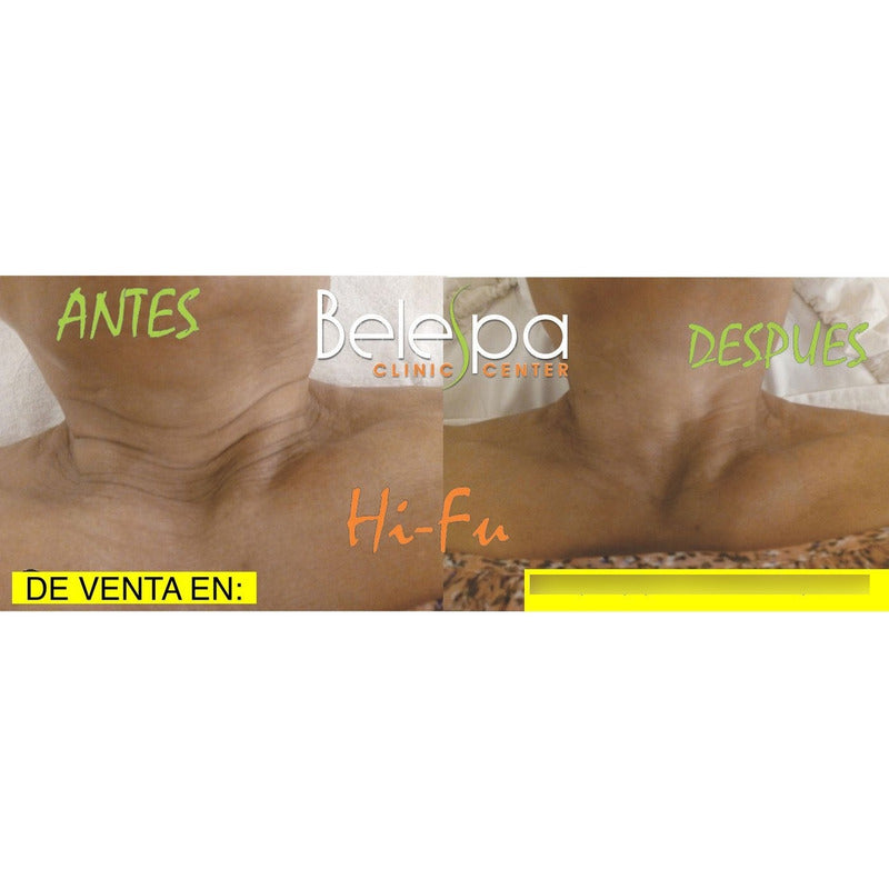 Minihifu Facial Corporal+masajeado Cuello Papada Lifting+gel